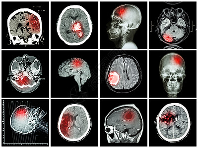 脑部疾病的集合 脑部 CT 扫描和 MRI 显示脑梗塞 脑出血 脑肿瘤 基底神经节出血 开颅术后状态 保健概念中风诊断神经病电脑图片