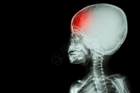 儿童与头痛脑疾病的X光片体孤立神经元病人孩子身体x射线脑血管学家疼痛中风婴儿图片