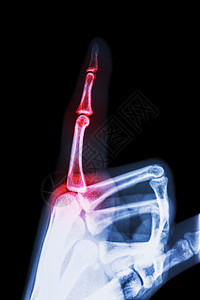 类风湿性关节炎 痛风性关节炎 拍摄 X 光食指和手 指向手指 并在手指处发炎痛风扫描放射科疾病方阵药品解剖学风湿病数字男人图片