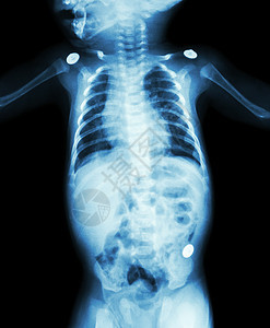 整个婴儿身体X光片肩膀医院解剖学新生儿科疾病放射科x光电影器官图片