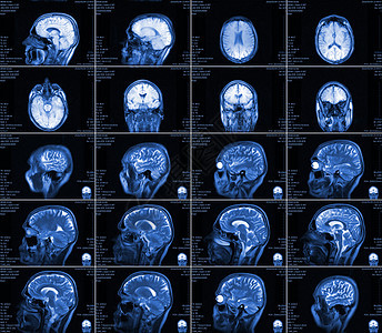 大脑的磁共振成像 没有明显的反常现象 笑声治疗实验室考试科学谐振辐射x射线颅骨技术放射科图片