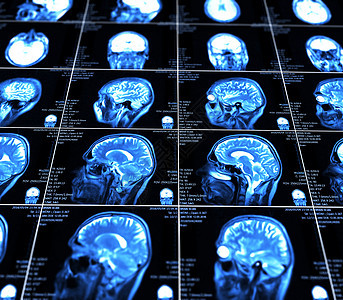 大脑的磁共振成像 没有明显的反常现象 笑声电影技术x光解剖学治疗诊断颅骨医院核磁共振病人图片