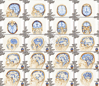 大脑的磁共振成像 没有明显的反常现象 笑声射线电影药品医院颅骨病人技术谐振断层x射线图片