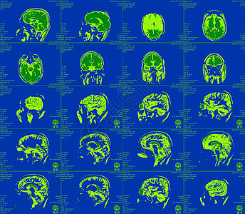 大脑的磁共振成像 没有明显的反常现象 笑声药品辐射治疗科学射线颅骨诊断放射科测试断层图片