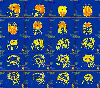 大脑的磁共振成像 没有明显的反常现象 笑声x射线医院解剖学病人谐振药品实验室诊断核磁共振电影图片