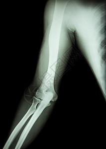正常手臂 肘和前臂的胶片X光黑色背景x射线骨科保健射线卫生医院疼痛鹰嘴肱骨电影图片
