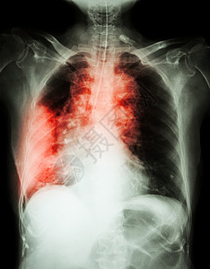 肺癌 电影胸腔X光显示右肺部质量 宽度介质 肺炎和右胸膜破损卫生医院身体x光感染药品肿瘤肋骨躯干纵隔图片