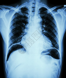 消化性溃疡穿孔 胸部X光片显示由于胃溃疡或十二指肠溃疡穿孔漏气 双隔膜圆顶下游离空气 手术条件和概念外科扫描医院疾病腹痛保健射线图片