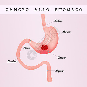 胃癌胃炎方案手术外科放射科消化系统冒号药品溃疡器官图片