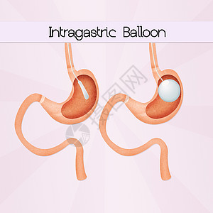 内气气球保健器官肥胖饮食减肥外科小袋卫生可调插图图片