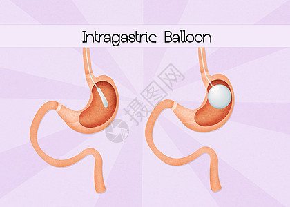 内气气球手术小袋减肥肠子可调饮食保健肥胖外科器官图片