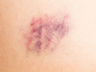 对受伤妇女腿皮的伤痕进行擦伤药品损伤皮肤闭合性创伤船只血肿保健毛细血管紫色图片