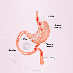 减少胃部的胃道切除术卫生手术减肥肥胖肠子饮食保健外科器官插图图片