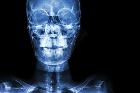 右侧的正常人头骨和空白面积卫生x光诊断骨骼外科手术x射线医院射线男人图片