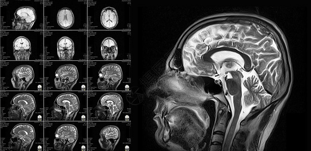 脑电磁共振成像谐振解剖学断层药品放射科技术考试辐射实验室x射线图片