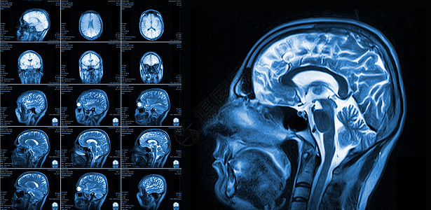 脑电磁共振成像颅骨解剖学治疗病人x光测试疾病电影考试辐射图片