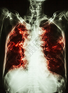 肺结核 老年患者胸片显示肺间质浸润和气管钙化 可见气管形状细菌结核放射科肺炎药品病人诊断男人医生x光图片