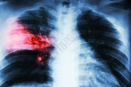 Lobar肺炎 薄膜胸X射线显示 由于肺结核感染 右中叶的甲状腺渗入药品感染疾病病人脑叶x光电影科学蓝色解剖学图片