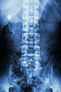 X射线胶片 KUB(肾脏-尿素-膀胱) 显示右肾结石(左侧圆形)图片