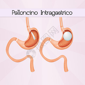 内气气球小袋外科肠子可调减肥保健饮食卫生器官插图图片