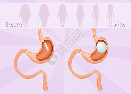 内气气球外科手术可调小袋肥胖插图卫生器官减肥饮食肠子保健图片