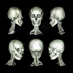 正常的人类头骨和宫颈脊椎都指向了所有方向x射线创伤射线断层解剖学医生身体颈椎病椎骨病人图片