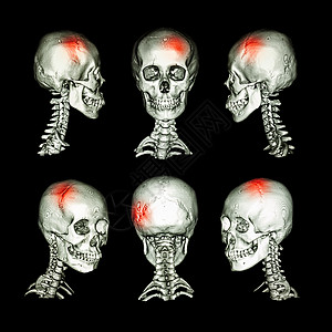 CT扫描和3D头部和子宫颈脊椎图像 使用此图像进行中风 头骨骨折 神经状态事故断层卫生科学颈椎病骨科x射线颅骨疼痛病人图片