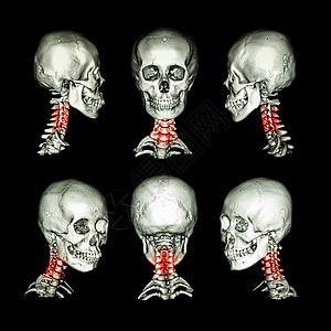 颅骨和颈部的 CT 扫描和 3D 图像 将此图像用于颈椎病 脊椎滑脱 脊椎炎 脊柱外伤情况骨科椎骨男人肌肉x光扭伤手术疼痛x射线图片
