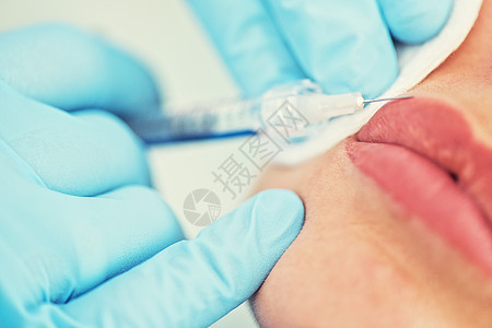 女人的嘴唇被注射皮肤科皱纹手套注射器护理化妆品诊所临床手术外科图片