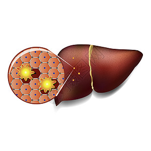 被毒素攻击的肝细胞坏死小叶组织纤维化肠胃细胞癌症保健解剖学代谢图片