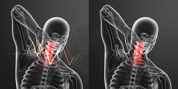 3d 说明  颈部疼痛脖子教育辐射生物骨干椎骨生物学病人胸部放射科图片