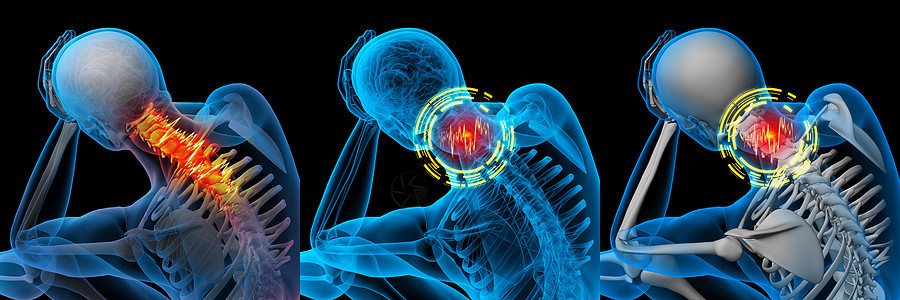 3d 说明  颈部疼痛x射线外科椎骨背痛药品手术躯干伤害病人科学图片