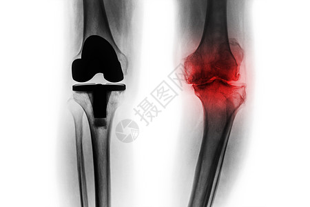 骨眼关节炎膝部和人工关节的X光片完全更换膝盖 孤立的背景骨骼骨关节炎手术病人假肢腓骨x光治疗外科骨科图片