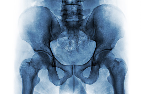 正常人类骨盆和臀关节的X光片x光考试电影诊断扫描蓝色股骨男人髂骨骨科图片