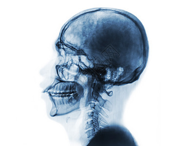 X光正常头骨和宫颈脊椎 横向视图 反颜色风格男人x光医院神经学家蓝色颅骨骨科卫生脊柱颈椎病图片