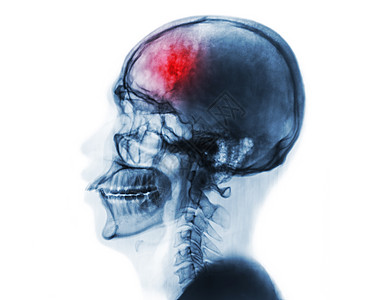 脑血管事故 头骨和宫颈脊椎的X光胶片x射线脑血管事故学家病人x光创伤骨骼颅骨椎骨图片