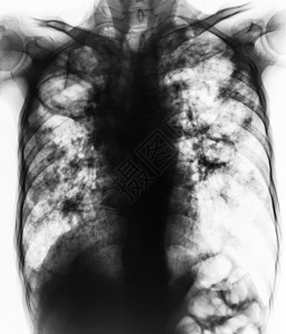 肺结核 胸部 X 光片显示由于结核分枝杆菌感染导致双肺纤维化 空腔 间质浸润躯干医院诊断扫描肋骨x射线身体细菌肺炎药品图片