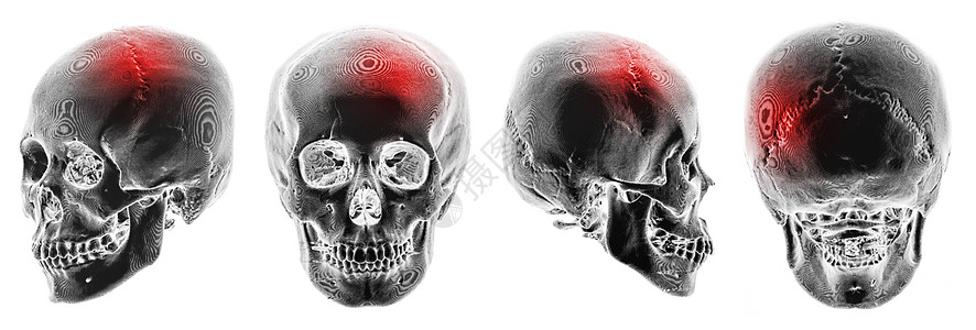 中风 脑血管意外 人类头骨 3D CT 扫描 多视图 反转颜色样式解剖学头痛骨骼事故增值税x光收藏x射线断层射线图片