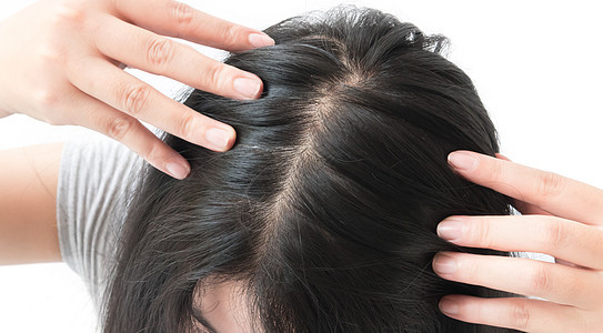 妇女因保健洗发水和beau而严重理发问题医疗保险头皮帮助梳子损失秃头头发男性假发发型背景图片