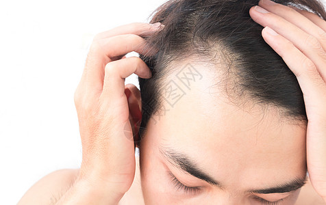 年轻人担心失去毛发的问题 健康护理洗发水假发梳子治疗移植头皮帮助发型秃头男性医疗背景图片