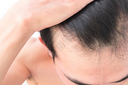 年轻人担心失去毛发的问题 健康护理洗发水假发移植损失造型师头皮男人帮助医疗头发梳子背景图片