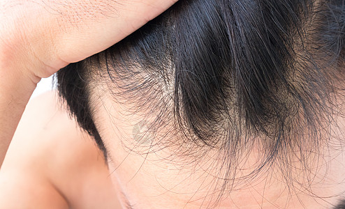 年轻人担心失去毛发的问题 健康护理洗发水治疗损失头皮男性医疗造型师假发梳子移植白色背景图片