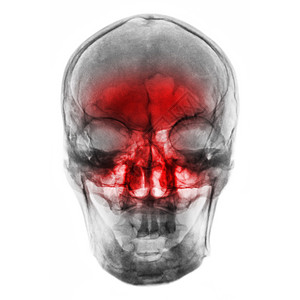 Sinusitis 人体头骨片X光片 因鼻炎发烧疼痛偏头痛药品医院卫生上颌筛骨疾病x光颅骨图片