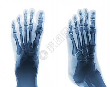 电影X光片都是正常的人类脚身体医院脚跟男人骨骼解剖学跗骨x射线扫描创伤图片