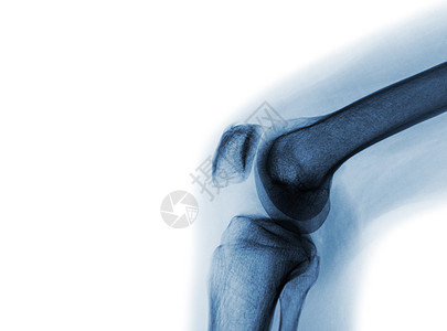 正常膝关节X光片射线股骨扭伤扫描病人髌骨膝盖解剖学疼痛x射线图片