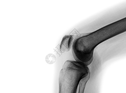 正常膝关节X光片男人疾病医院射线腓骨放射科扭伤大腿药品骨骼图片