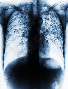 肺部肺结核药品身体射线病人细菌肋骨结核病诊断x光扫描图片