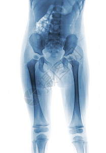 儿童影片X光体身体下半部大腿臀部躯干腰椎腰部骨盆x光股骨婴儿蓝色图片
