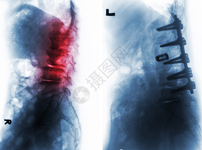 外科手术前后的脊柱性硬化症腰椎经营放射科扫描金属身体椎骨射线脊柱治疗图片