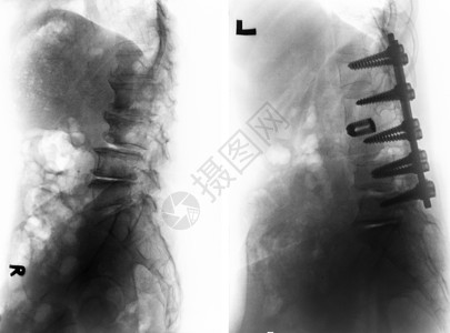 外科手术前后的脊柱性硬化症疾病射线腰椎金属卫生放射科骨科椎骨疼痛脊椎图片